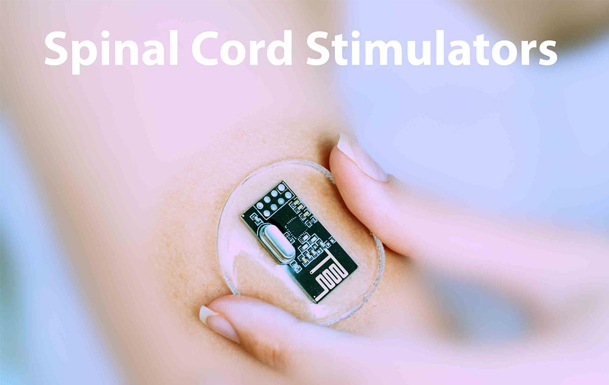 Picture of a spinal cord stimulator implant.