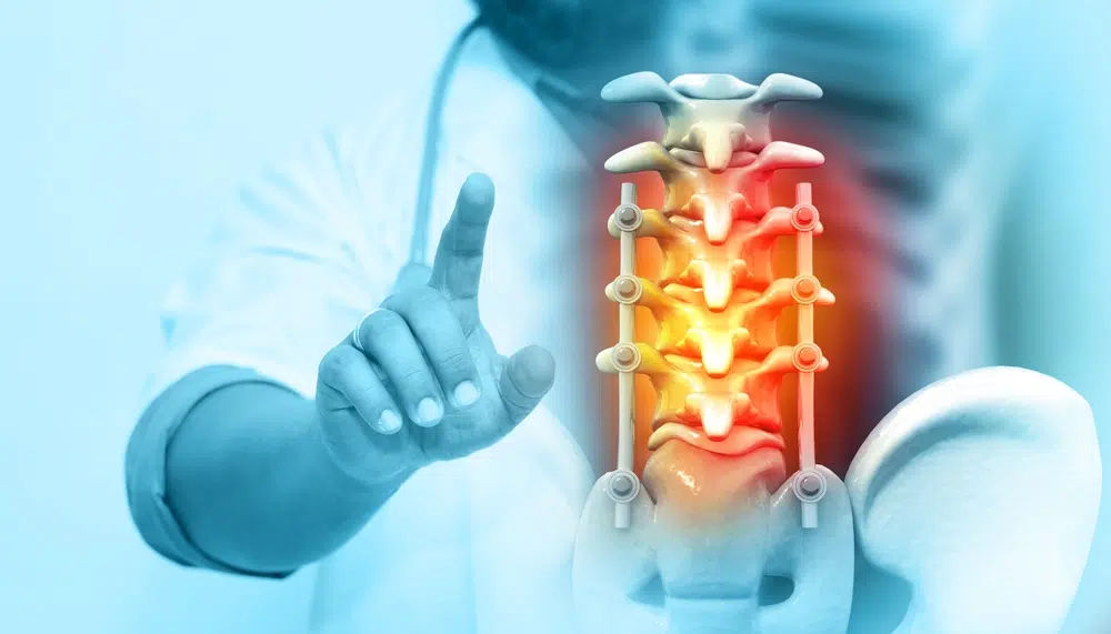 Doctor demonstrating spinal column with surgical hardware highlighting minimally invasive spine surgery technique.