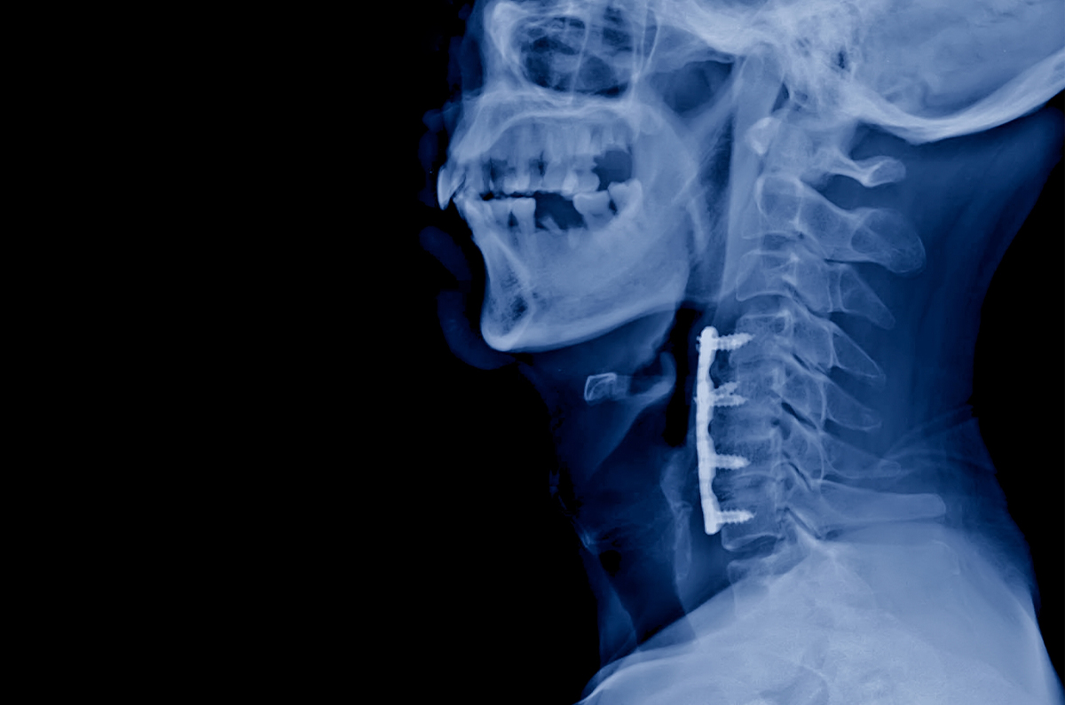 Lateral cervical spine X-ray showing surgical hardware and fusion levels used for preoperative surgical evaluation