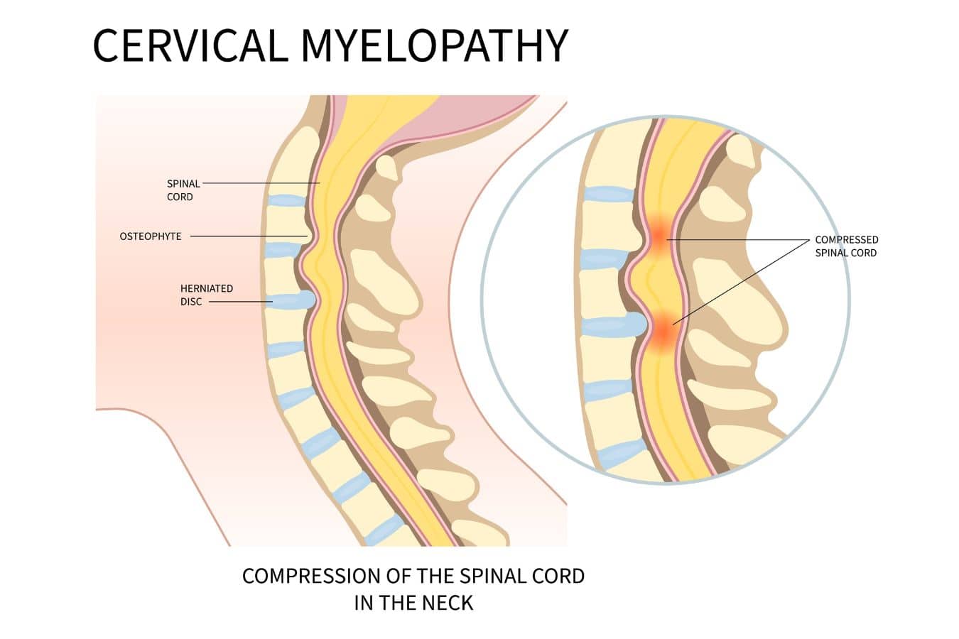 Diagram showing cervical myelopathy with spinal cord compression from herniated disc and osteophytes in the neck