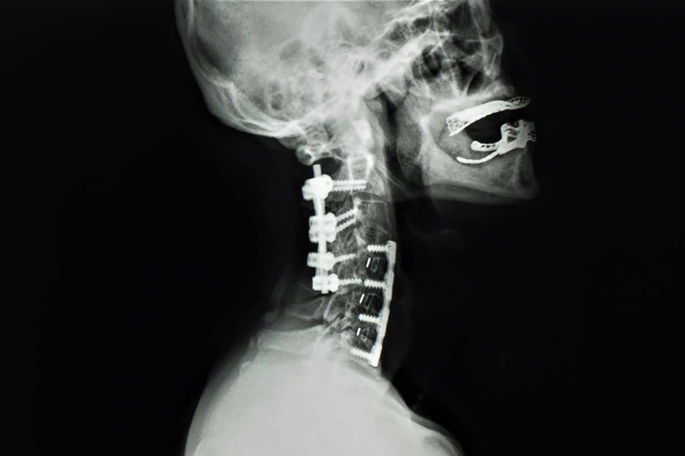 Lateral cervical spine X-ray showing fusion hardware and instrumentation used to treat spinal cord compression