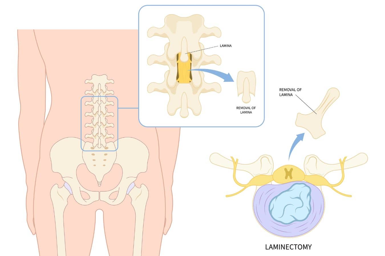 Medical diagram showing laminectomy procedure with lamina removal and nerve decompression in lumbar spine