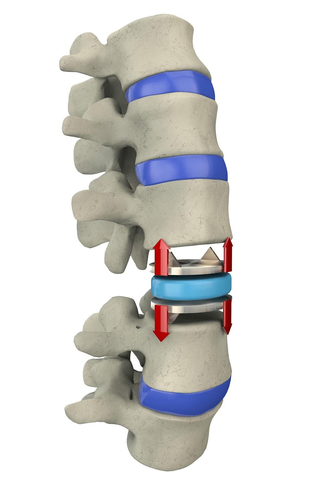 lumbar-artificial-disc-replacement-01